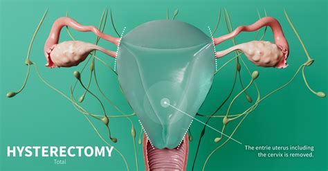 cost of hysterectomy procedure in the philippines|Hysterectomy: Why It's Performed, What To Expect After Surgery.
